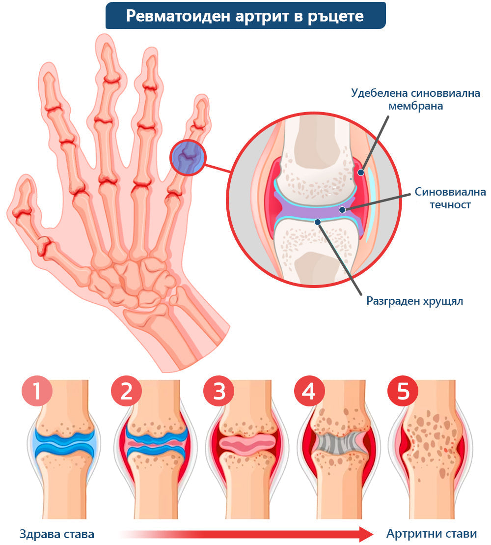 🍀🍀ArthroFree™ Облекчаващ болката крем за кости с пчелна отрова🐝(Специално за по-възрастни и AAOS препоръчва) x