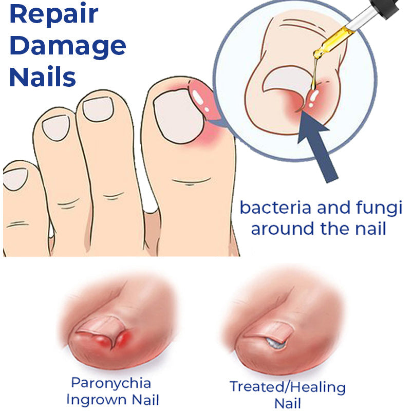 🔥German ToenailCare™ Removal Paronychia Oil 🔥(Limited time discount Last 30 minutes)