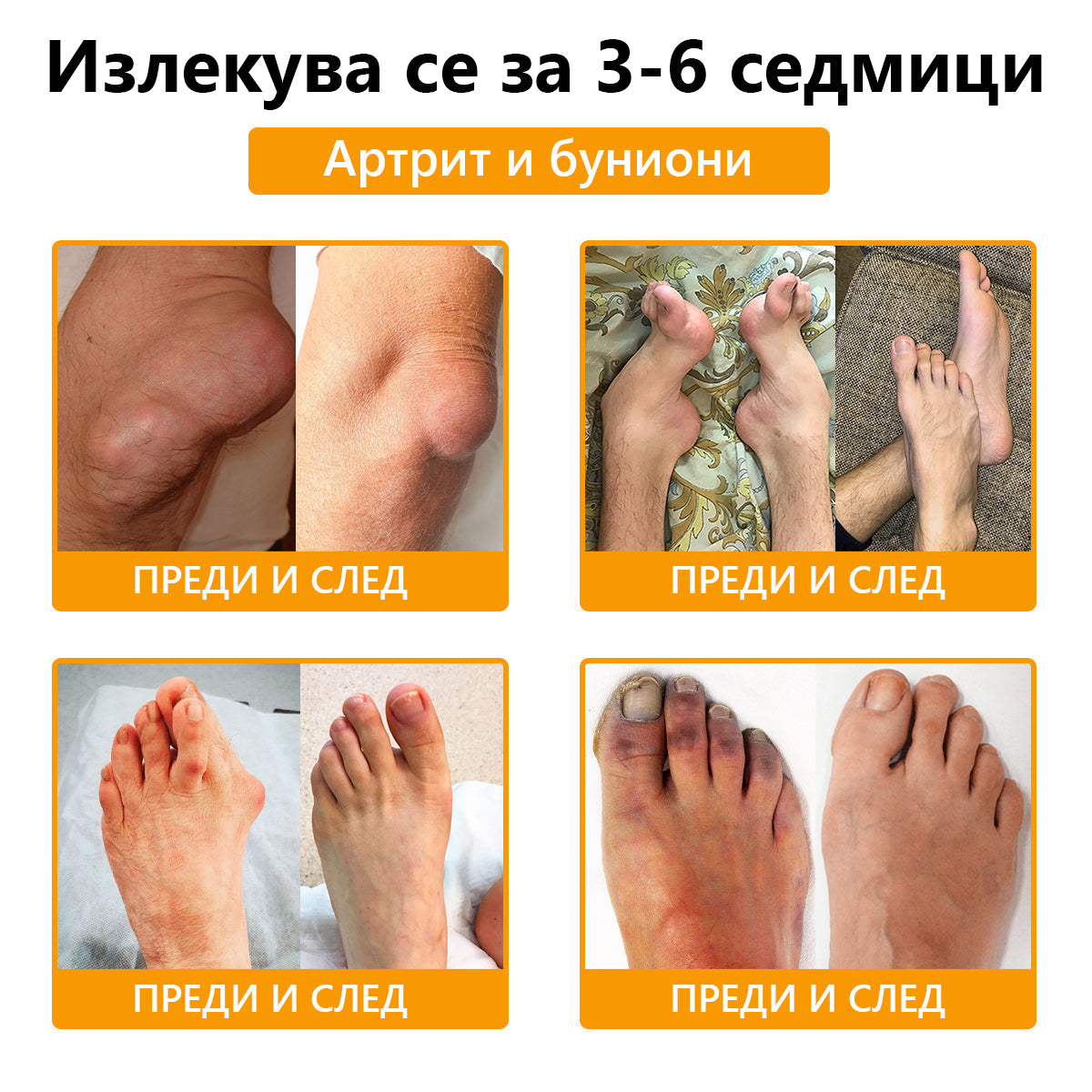 🍀🍀ArthroFree™ Облекчаващ болката крем за кости с пчелна отрова🐝(Специално за по-възрастни и AAOS препоръчва) x