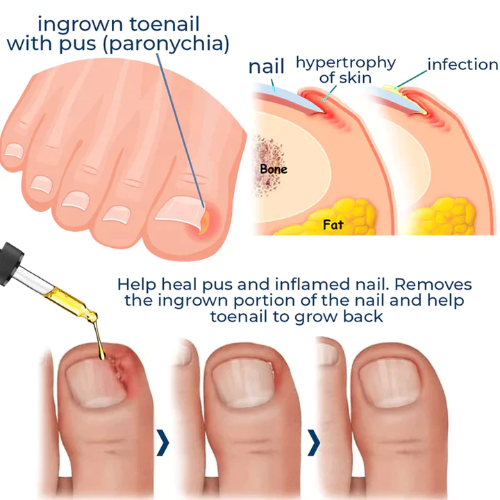 🔥German ToenailCare™ Removal Paronychia Oil 🔥(Limited time discount Last 30 minutes)