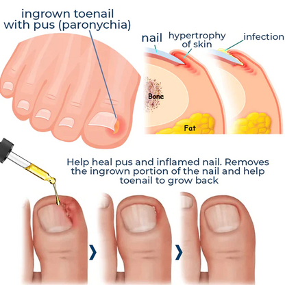 🔥German ToenailCare™ Removal Paronychia Oil 🔥(Limited time discount Last 30 minutes)