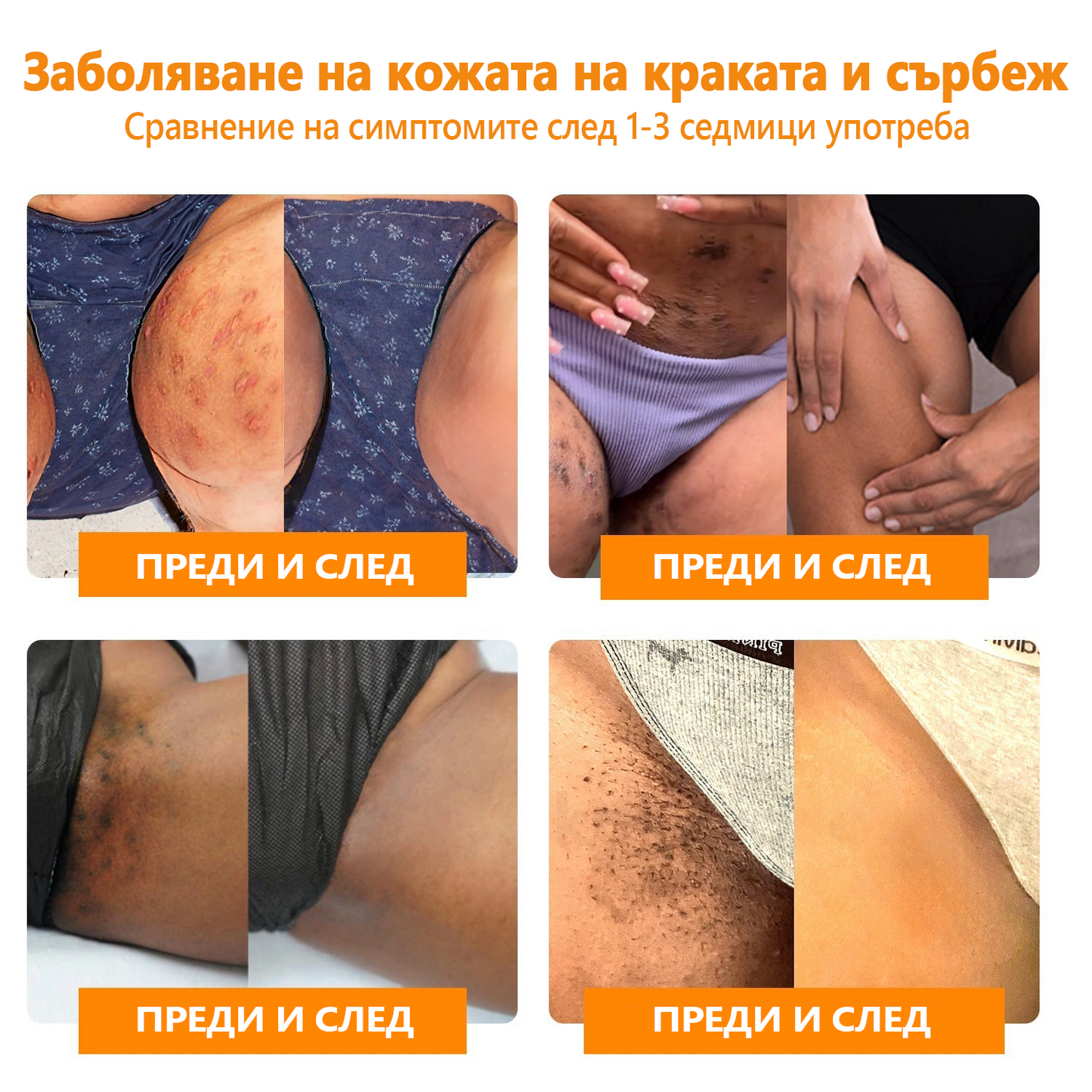 🌐🌐LIPOGO™ Крем за премахване на брадавици и етикети от пчелна отрова (👨‍⚕подходящ за всички типове кожа) 🐝(🔥"Промоция за последния ден" 70%)